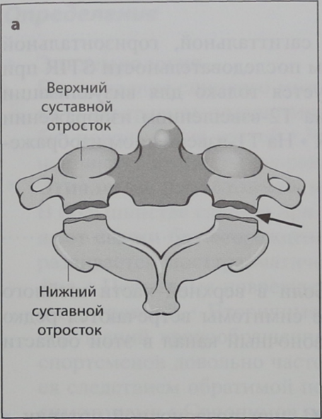 Снимки МРТ и КТ. Перелом повешенных