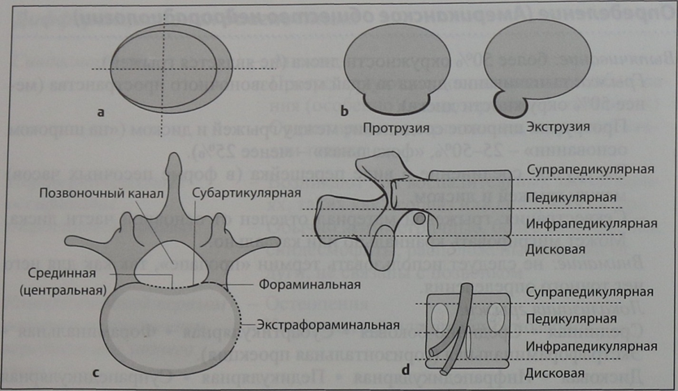 Снимки МРТ и КТ. Грыжа диска